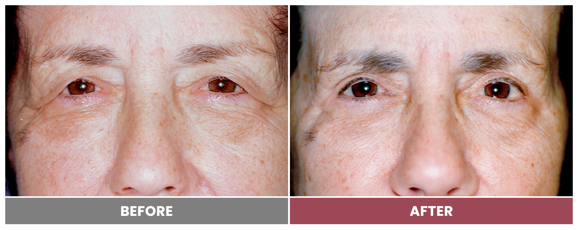 Upper Blepharoplasty - Case 33
